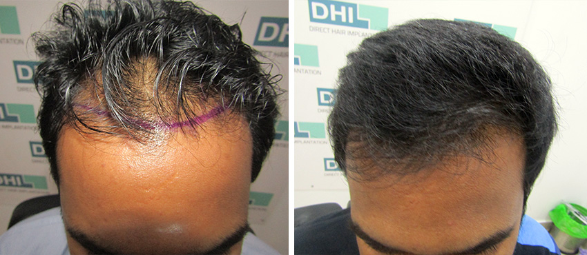 DHI before & after hair transplant results